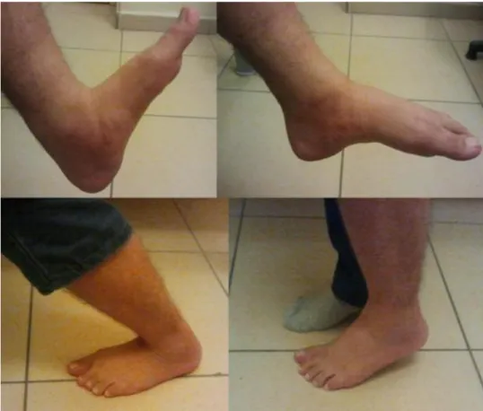Fig. 4 All patients were able to perform heel raise test