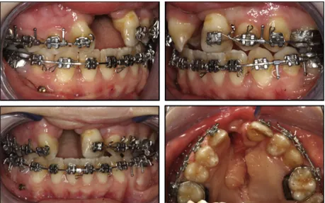 Fig 8. Intraoral photographs after orthodontic treatment.
