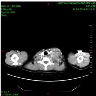 Figure  3:  Lymph  node  structure  with  epithelial  tumor  metastasis  (HEx10). 