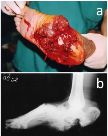 Fig. 1 Clinical appearance of 21-year-old male patients with com- com-plex hind foot injury (a)
