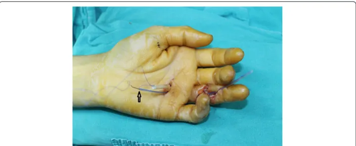 Figure 3 The straightened needle and the distal end of the suture are threaded through the catheter