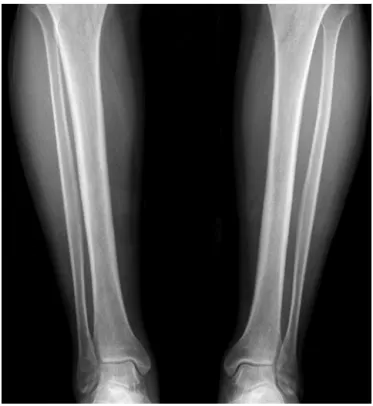 Fig. 1. Bilateral antero-posterior X-ray graphy of tibias.