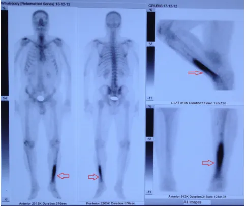 Fig. 6. Bone scan of left tibia.