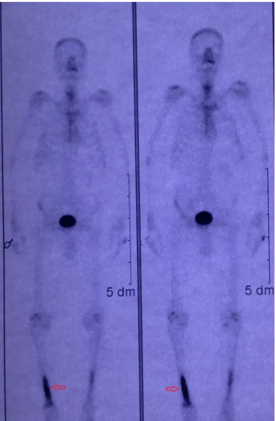 Fig. 7. Bone scan of right tibia.