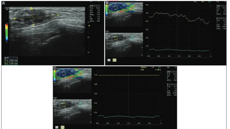 Figure 1 (A-C): B‑mode  US  (A)  shows  an  ovoid  shaped,  hypoechoic  solid  mass  with  microlobulated  borders.  US  elastography  images  (B and C) demonstrate an almost completely blue mass with green surrounding tissue