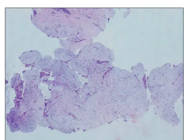 Figure 4: Histopathology slide shows fibroadenoma with mild mixoid  stroma (HE ×40)