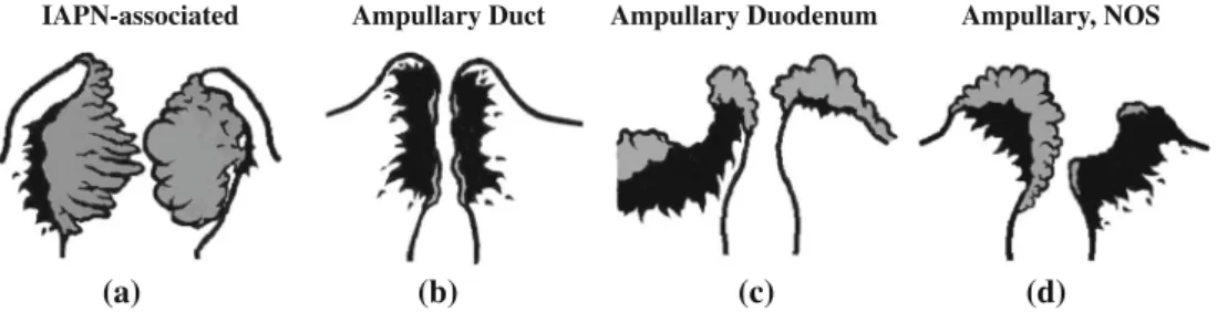 FIG. 1 Site-specific classification of ampullary carcinoma. a IAPN- IAPN-associated carcinomas are characterized by a prominent pre-invasive neoplasm (gray areas) that grows predominantly as an exophytic mass within the distal ends of the common bile duct 