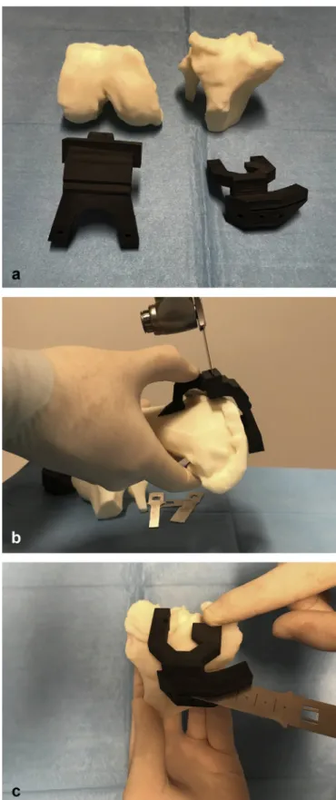 Fig. 1. a: Patient speciﬁc instruments (PSI) and 3D printed solid models of the patient's femur and tibia