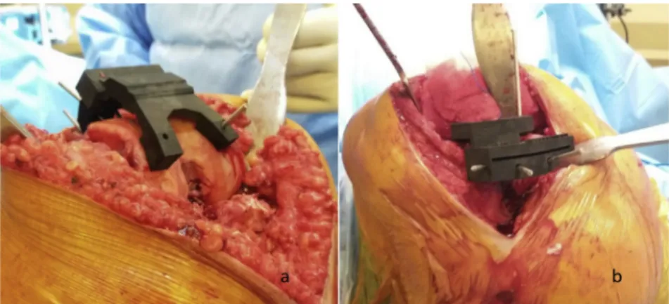 Fig. 2. a and b: Femoral and tibial patient speciﬁc instruments coupled with patient's bones during the surgery, before resection.