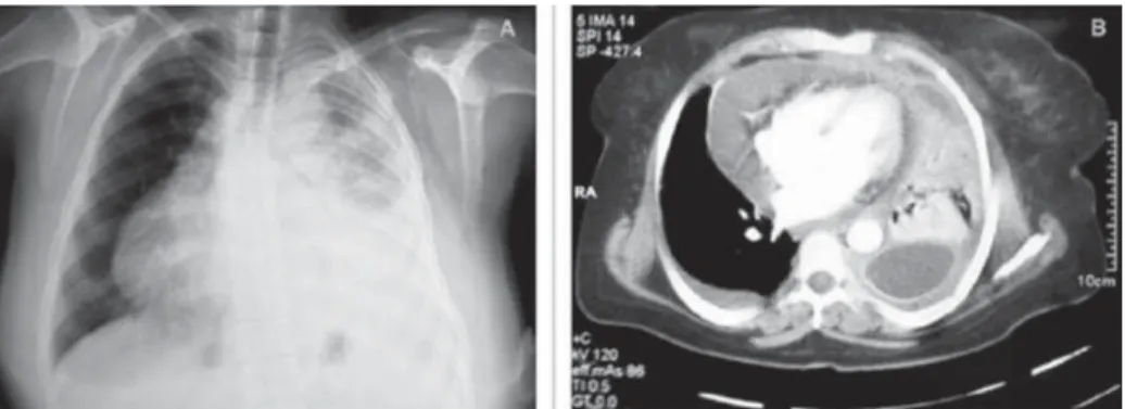 Figure 2.  Pericardiocentesis via the right parasternal approach.