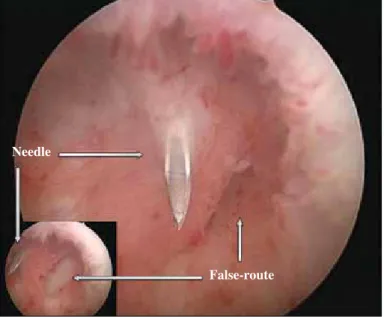 Figure 2. Antegrade endoscopic view of a false route. 