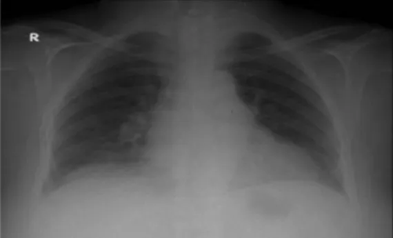 Figure 1 Widened mediastinum in chest X-ray.