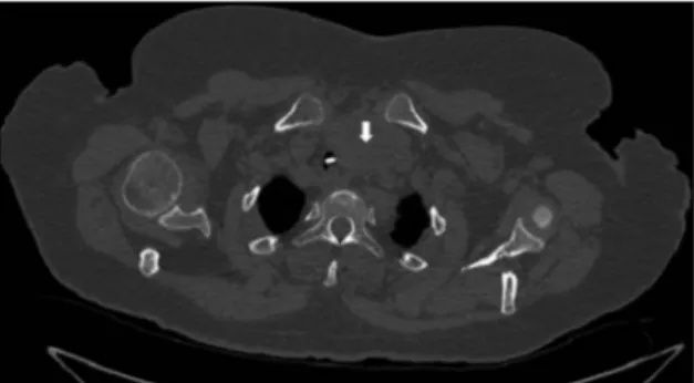 Figure 3 Angiographic demonstration of in-stent (95%) restenosis in the left anterior descending artery.