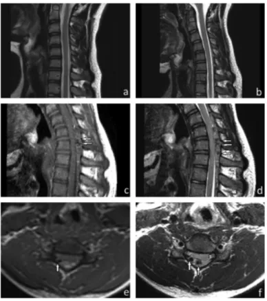 FIG. 1. a-f. Hirayama disease. Normal magnetic resonance imaging findings on the  sagittal T2-weighted images in a neutral position (a) and in slight flexion (b)