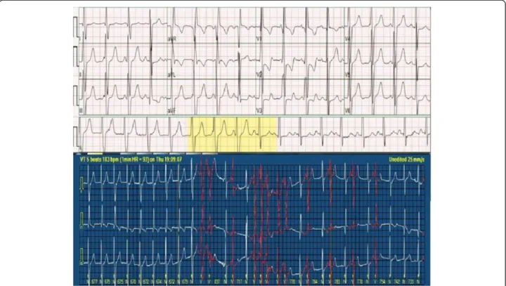 Figure 4 Nodal rhythm (top strip) on ECG and non-sustained VT attack (bottom strip) on 24-hour Holter ECG.