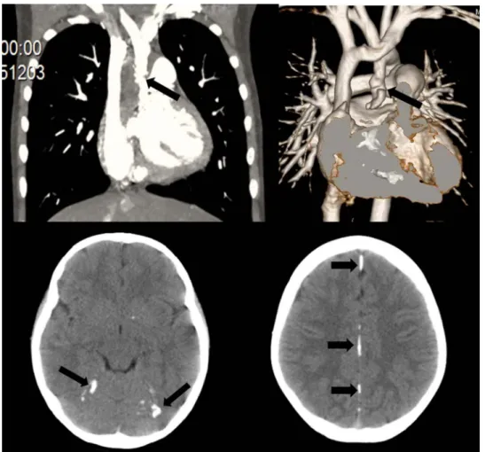 Figure 1 Critical supra-aortic stenosis at the ascending aorta (upper left side, arrow) at CT