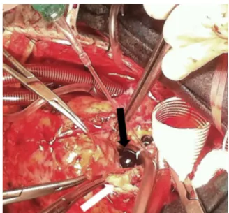 Figure 2 Operative view indicating the severe calci ﬁcations and dissection formation at the ascending aorta (white arrow)