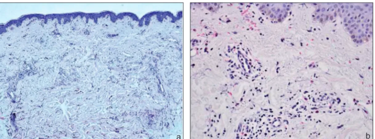 FIGURE 2: a: Epidermis is regular. Note the perivascular and interstitial inflammation in the dermis (HEx40); b: Perivascular and interstitial eosinophil, neutrophil and lymphocytic infiltration (HEx200).