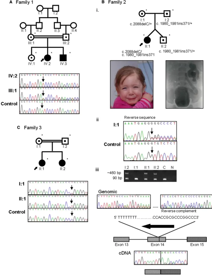Figure 1. Identification of Mutations in LRIG2 in Three Families Affected by UFS Pedigrees and LRIG2 mutation analysis in families 1 (A), 2 (B), and 3 (C).