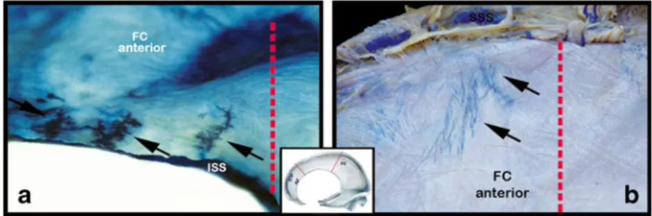 Fig. 1 a,b, c The falx cerebri had fenestrations of varying shapes at different locations: a An oval fenestration close to the inferior sagittal sinus located at the anterior third of the falx cerebri; b Multiple  fenestra-tions close to the superior sagit