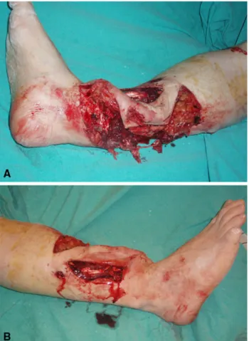 Fig. 3 Preoperative radiograph of the fractured left femur