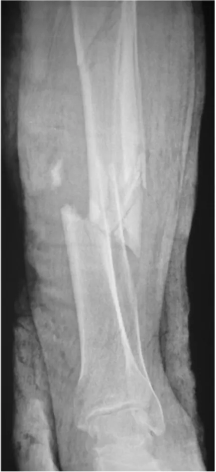 Fig. 5 An early postoperative radiograph shows that the fibula is seated well between the two poles of the tibia