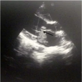 Figure 1 Echocardiographic image demonstrates the perforation and regurgitant jet on the anterior lea ﬂet (arrow).
