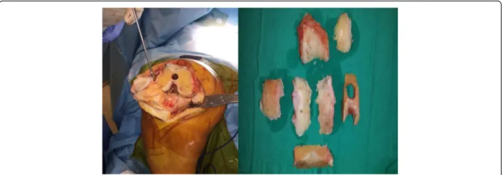 Fig. 2 Osteochondral tissue obtained during total knee replacement surgery