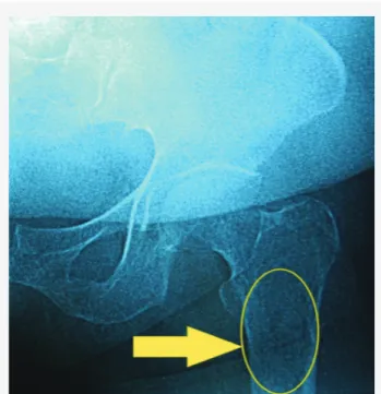 Fig. 1. A regular edged, multilocular destructive lesion located  at the subtrochanteric region of femur