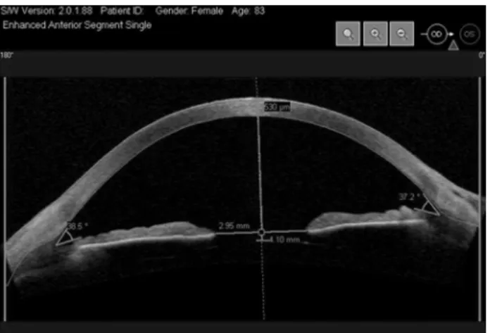 FIGURE 1. Measurements of anterior chamber angle width and depth with anterior segment optical coherence tomography.