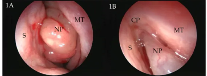 Figure 1. An endoscopic nasal examination with 30  degree telescope shows large polypoid lesion with  pedicle arising from the cribriform plate