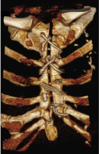 Fig 1. Three-dimensional computed tomography demonstrates the sternal nonunion with the wires cutting the bone.