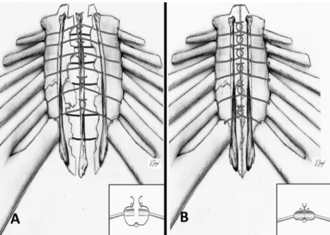 Fig 2. Illustrations demonstrating the ﬁbula allograft sandwich technique (the inlet  ﬁg-ures demonstrate the technique  crossection-ally)