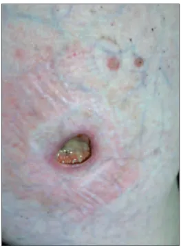 FIGURE 1a: A deep ulcer of 2x2 cm covered with a serous-purulent exudate on the right lower quadrant of the abdomen.
