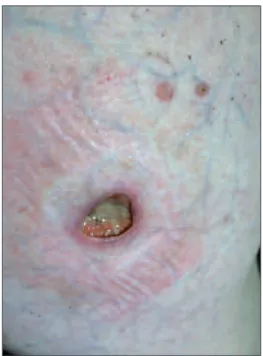 FIGURE 1a: A deep ulcer of 2x2 cm covered with a serous-purulent exudate on the right lower quadrant of the abdomen.