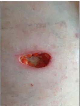 FIGURE 3: The partially healing ulcer one month after therapy..