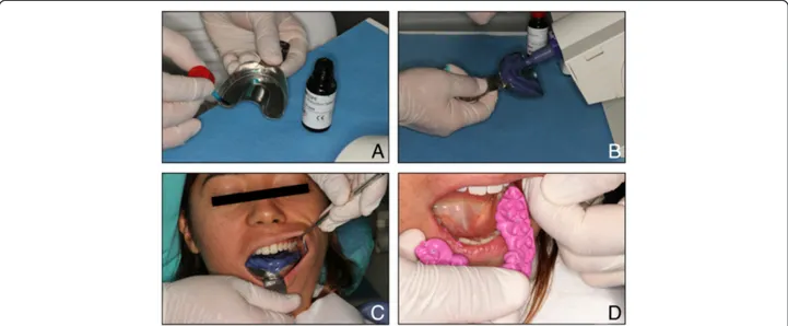 Figure 1 Conventional impression technique. Conventional impression technique. A) Adhesive application, B) Impression tray loading, C) Upper and lower arches impression, D) Bite registration.