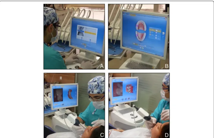 Figure 2 Digital impression technique. A) Entering patient information, B) Laboratory prescription, C) Upper and lower arches scanning, D) Bite scanning.