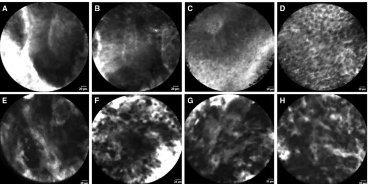 Fig. 3    In vivo confocal laser endomicroscopy images of low-grade  (a–d) and high-grade (e–h) upper urinary tract urothelial carcinomas: 