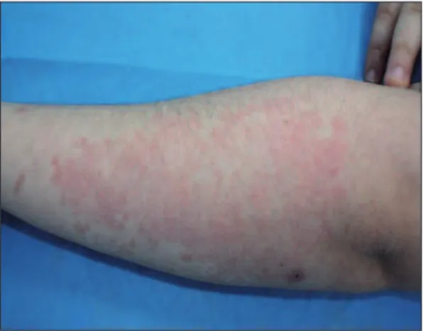 FIGURE 1: Red scaly plaque on her left forearm.