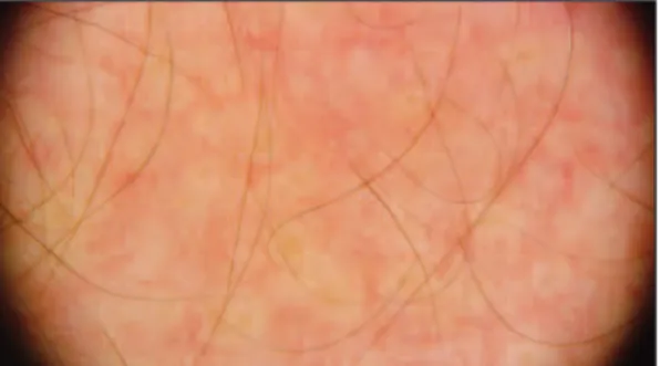 FIGURE 3: Dermoscopic findings revealed round/oval yellowish areas sur- sur-rounded by vessels of mixed linear and dotted morphology.