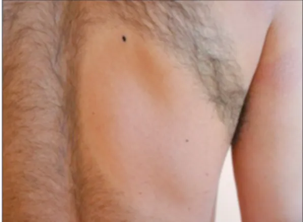 FIGURE 1: Erythematous slightly atrophic scale within alopesic site and  ery- ery-thematous atrophic macule on the right arm.