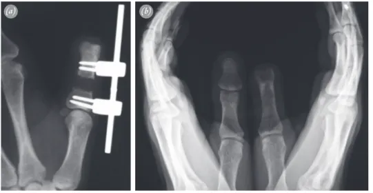 Fig. 3.  (a) Lengthening of the distal phalanx was initiated 10 days after the osteotomy; it was continued  until the tip of the proximal phalanx reached the middle of the opposite distal phalanx