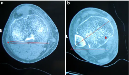 Fig. 2 Measurement of tibial rotation with CT slices. a The angle a between posterior cortex of tibia and transverse axes on the proximal slice