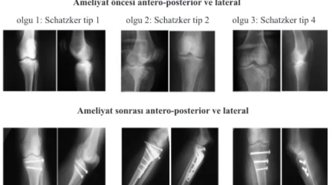 Şekil 3. Olgularda görülen komplikasyonlar.