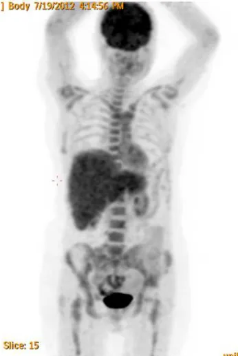 Figure  1.  (Maximum  intensity  projection)  The  anterior  view  of  a  patient  showing  diffuse  F18-FDG  uptake  of  the  liver  with  a  SUVmaxvalue  of  4.5  (normal:  3.2+0.8)  and  an  increase  in  liver  dimensions.