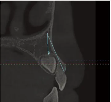 Fig. 1.  The distance between the terminal portion of the canalis  sinuosus (CS) and the region of the buccal alveolar ridge is  mea-sured on the sagittal plane.