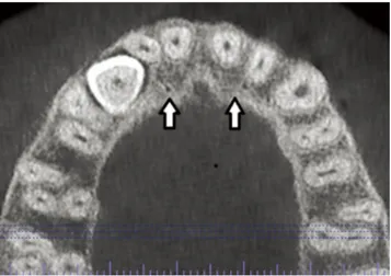Fig. 3.  Accessory bony canals run downward towards the alveolar  ridge.
