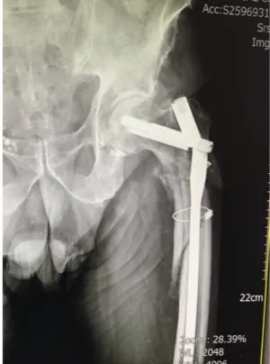 Fig. 4. Implant breakage.