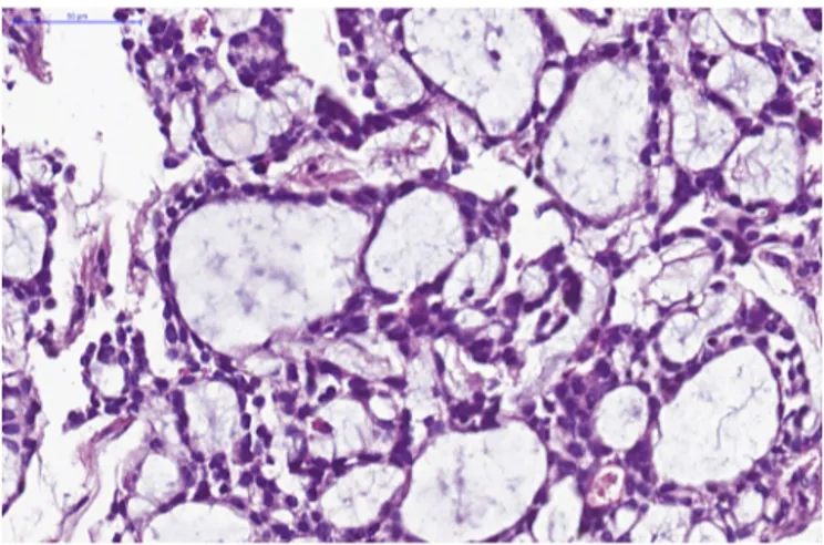 Fig. 2. Tubules and cribriform nests of basaloid cells lining cystic spaces ﬁlled with homogenous material [hematoxylin and eosin (H&amp;E); × 200].